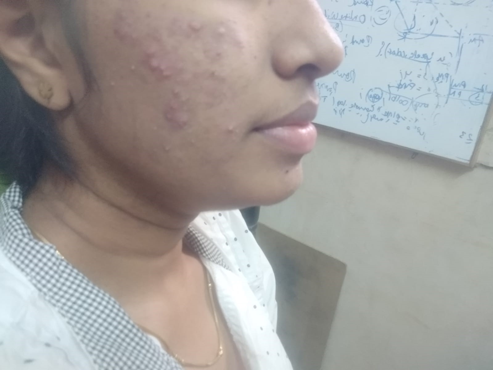 Acne Vulgaris 1